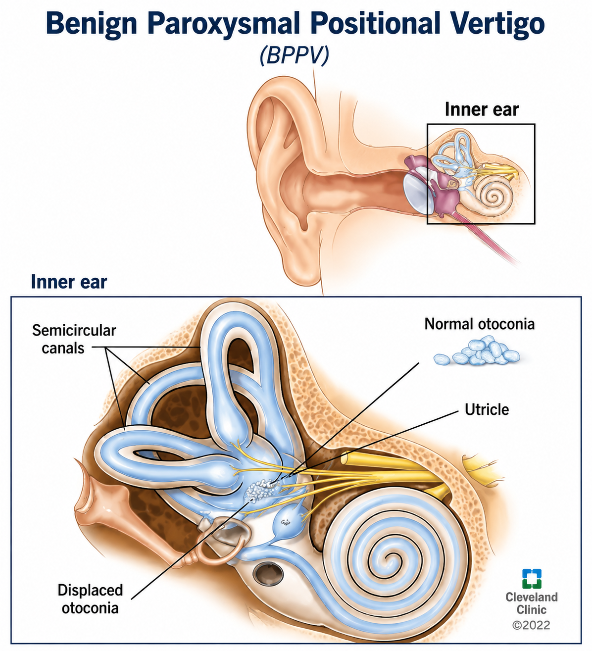 BPPV Overview